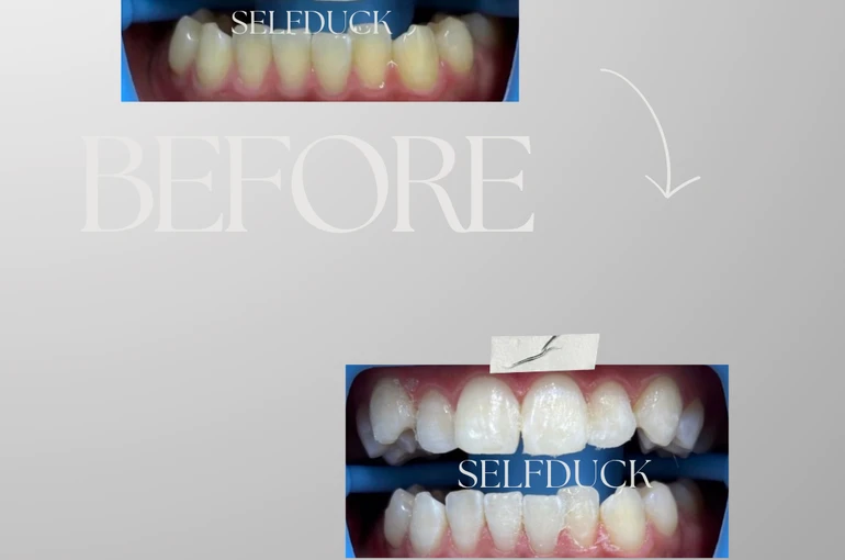    ホワイトニング　before→after　　白い歯　会津若松　   
